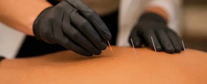 Close-up of dry needling therapy with gloved hands placing needles
